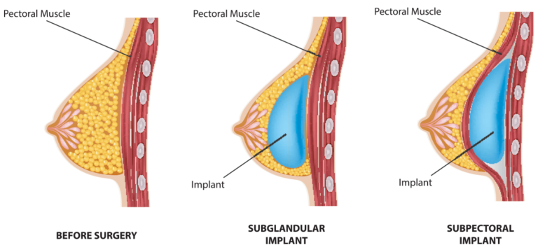 Breast Implant Types